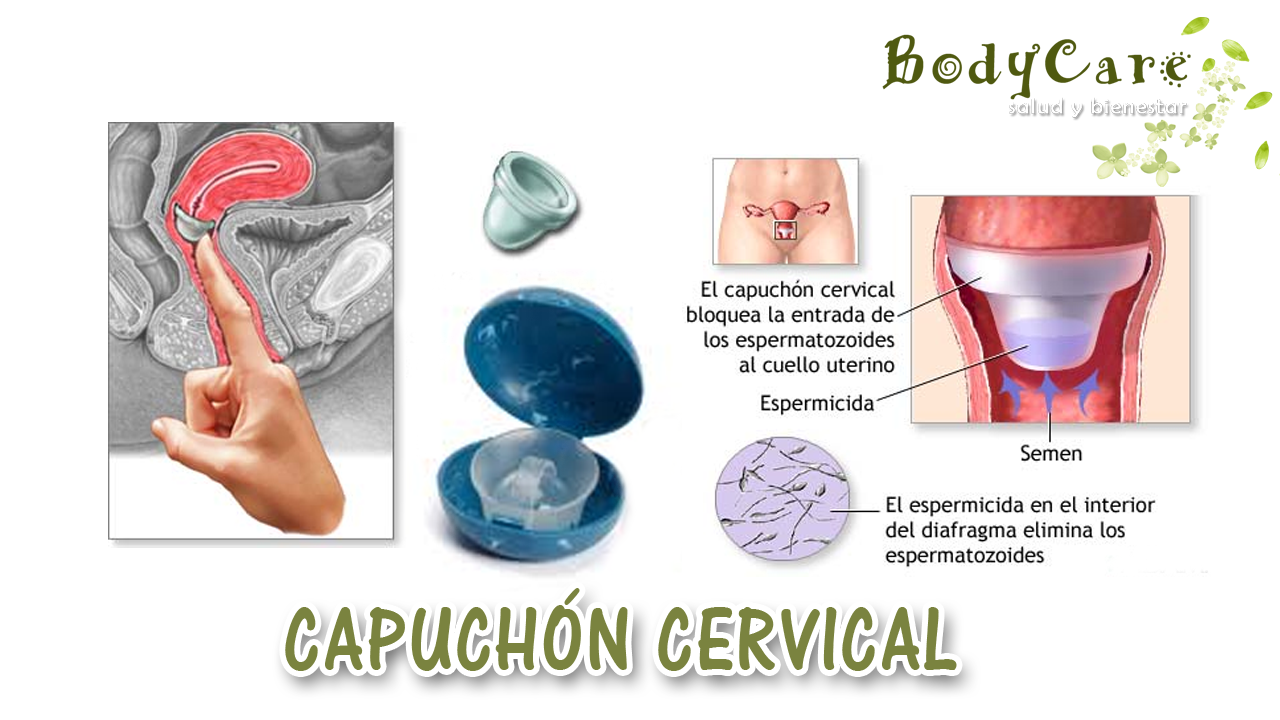 Resultado de imagen para capuchon cervical